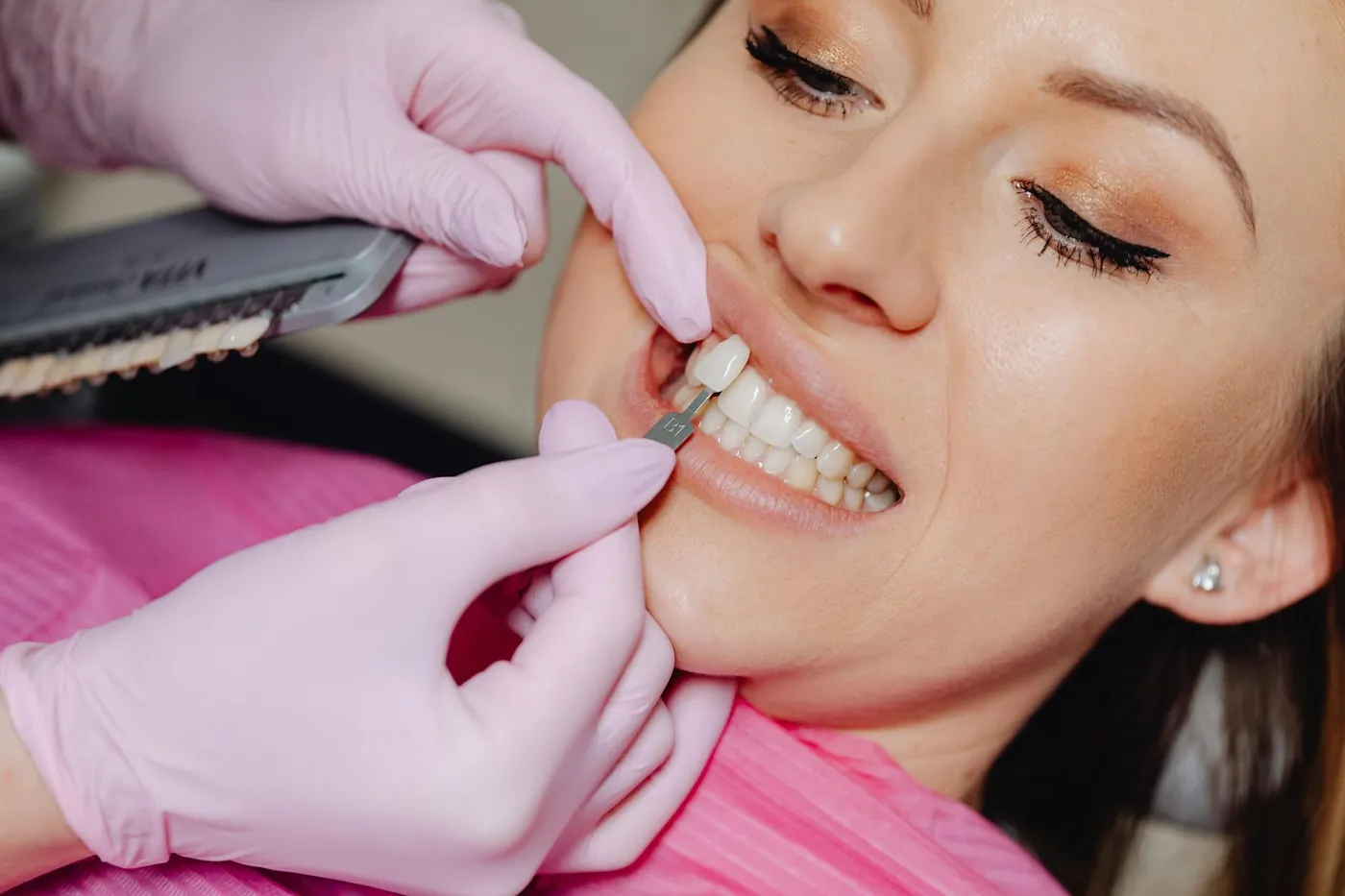 Selección de tono para blanqueamiento dental en Fashion Dent